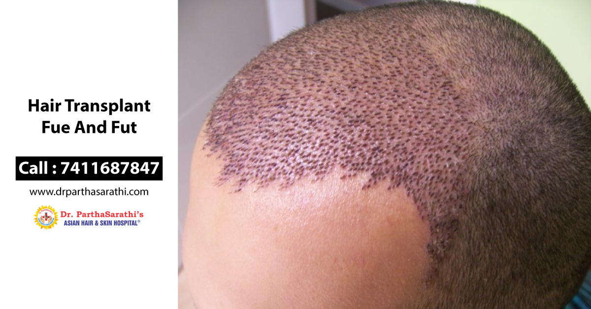 hair transplant fue and fut in Koramangala, Indira Nagar, MG Road, Bangalore